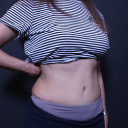 Tummy Tuck