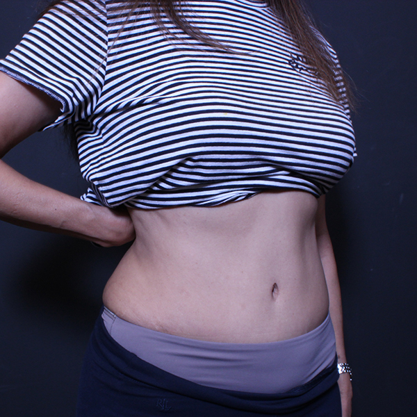 Tummy Tuck