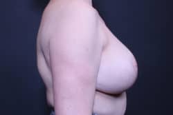 Breast Reconstruction