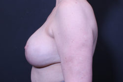 Breast Reconstruction