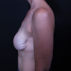 Breast Reconstruction