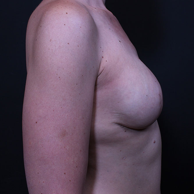 Breast Reconstruction