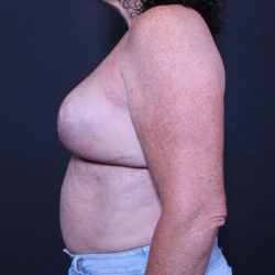 Breast Reconstruction