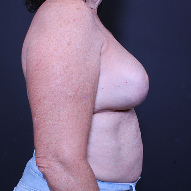 Breast Reconstruction