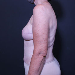 Breast Reconstruction