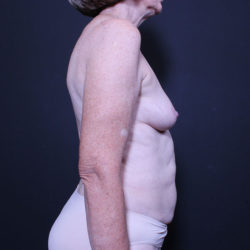 Breast Reconstruction