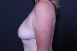 Breast Reconstruction