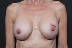 Breast Reconstruction