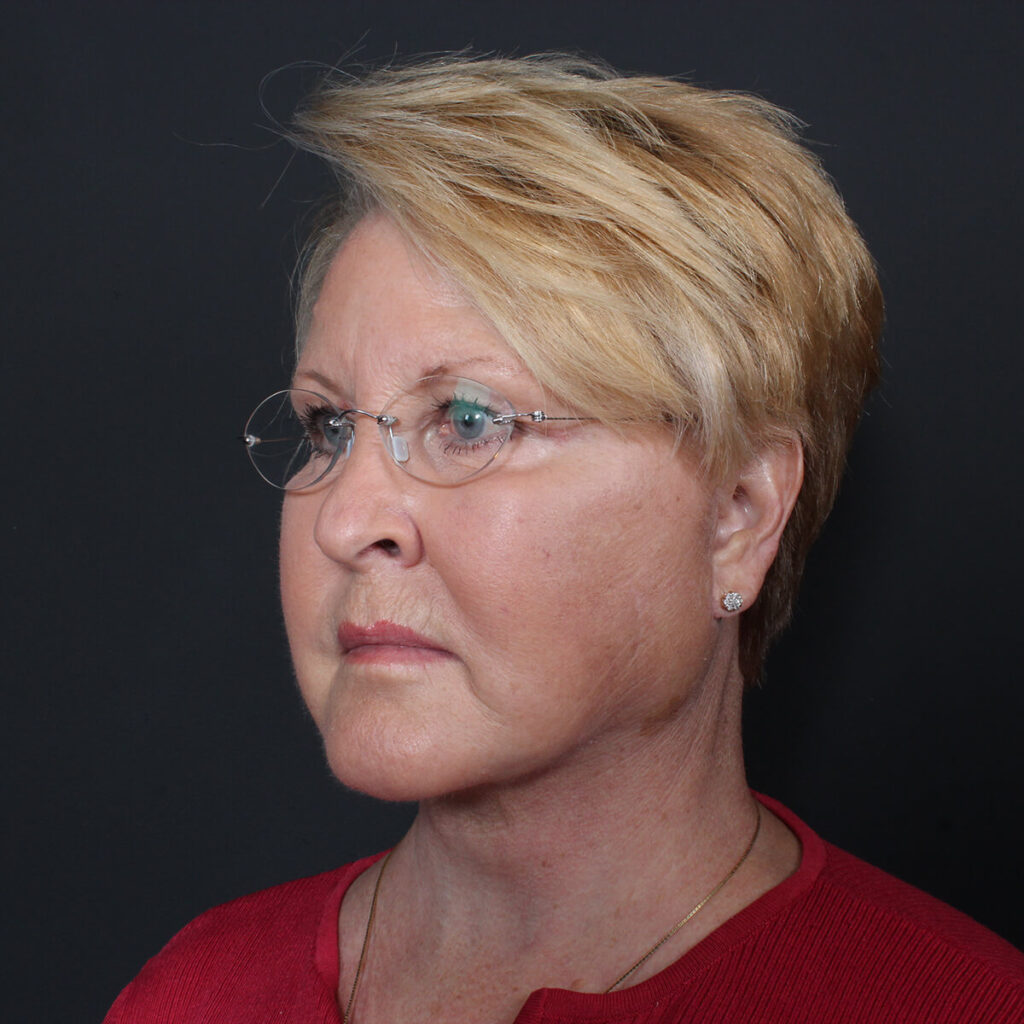 Facelift