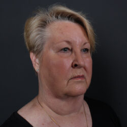 Facelift