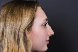 Rhinoplasty