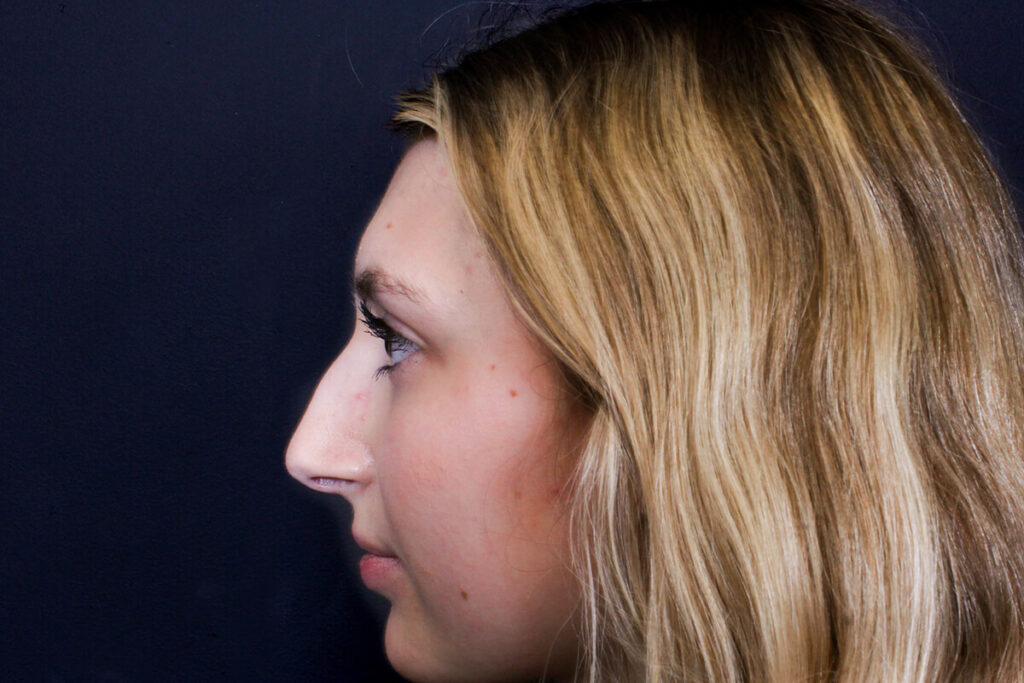 Rhinoplasty