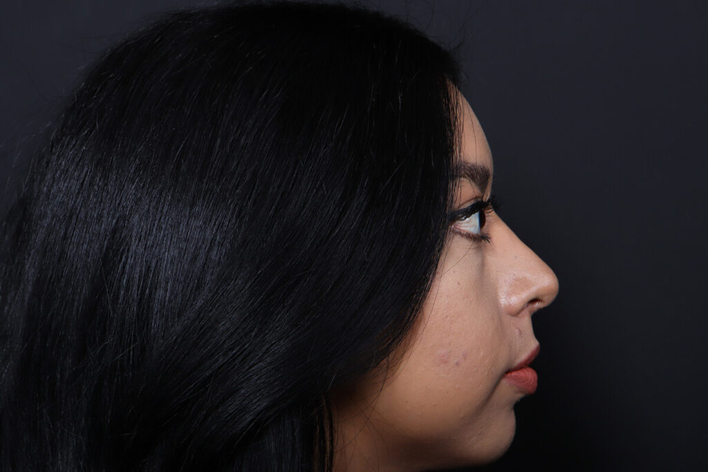 Rhinoplasty