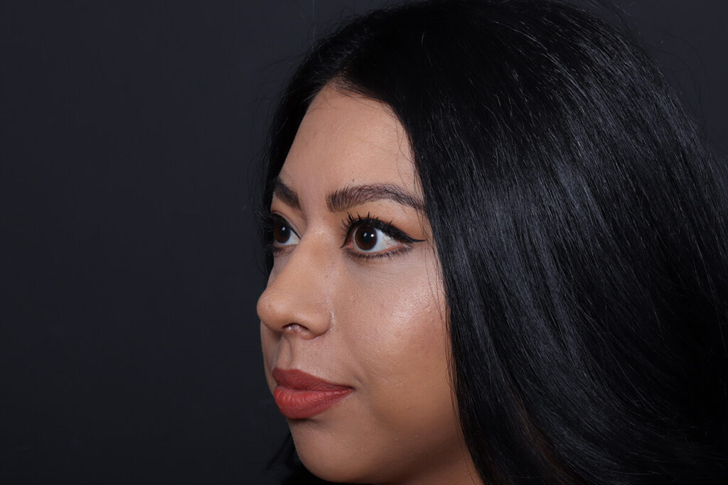 Rhinoplasty