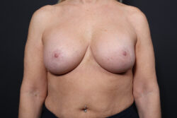 Breast Lift